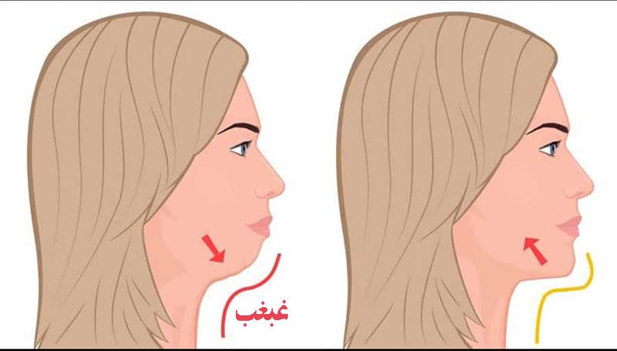 ساکشن غبغب