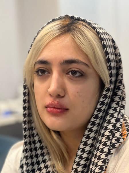بعد از تزریق ژل