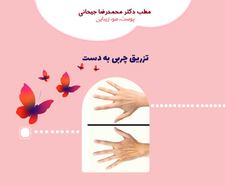 تزریق چربی به دست