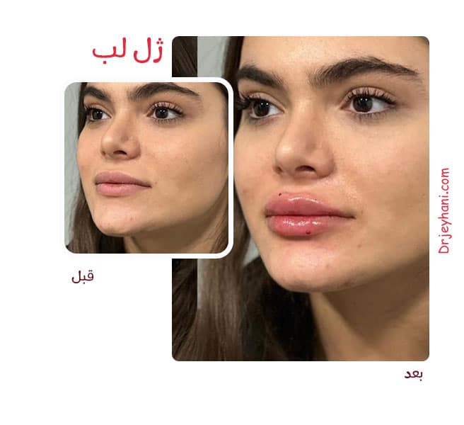 gel-lip5 نمونه کار تزریق ژل لب