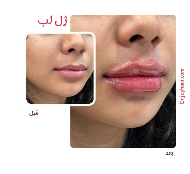 gel-lip6 تزریق ژل لب