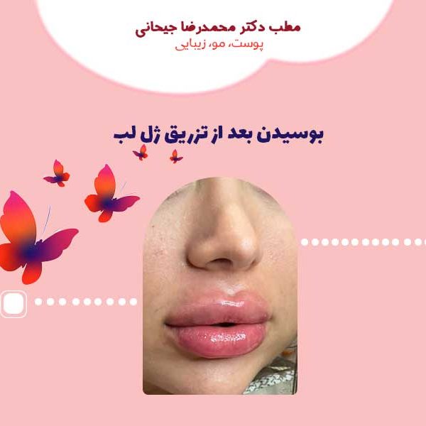 kiss بوسیدن بعد از تزریق ژل لب